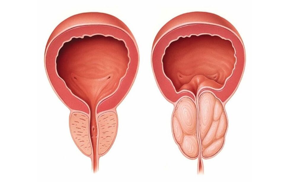 prostata normale e infiammata