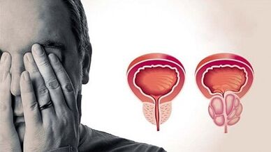 Le ragioni dello sviluppo della prostatite negli uomini