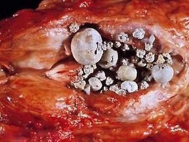 Calcoli nella ghiandola prostatica con prostatite calcolosa