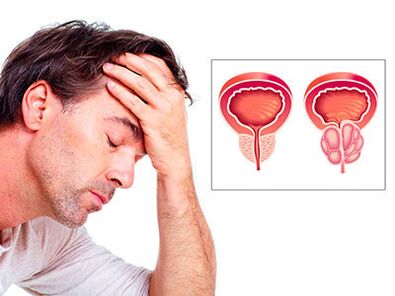 I sintomi della prostatite preoccupano un uomo