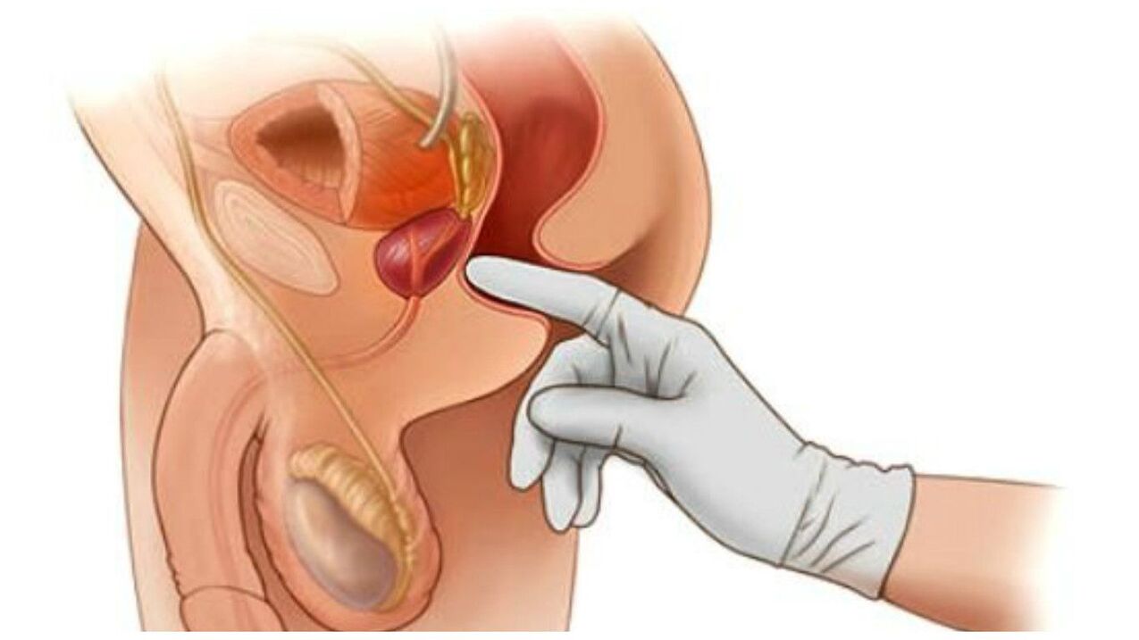 massaggio prostatico
