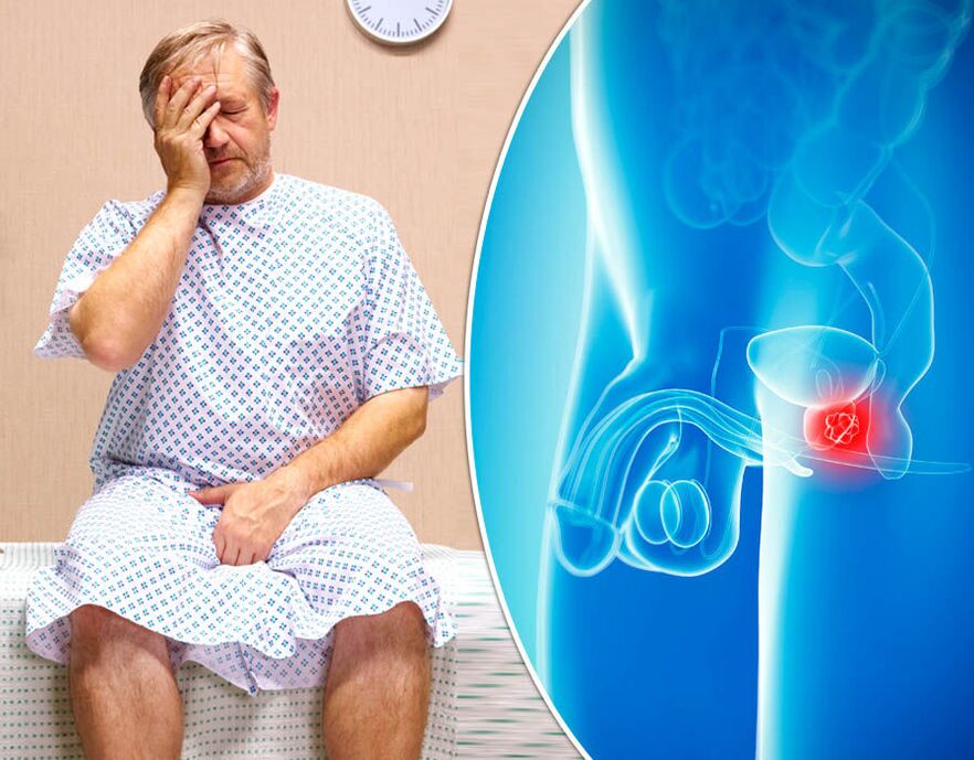 A un uomo con la prostatite viene diagnosticata una malattia