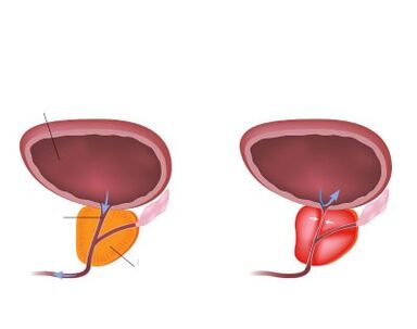 Prostata normale e infiammata